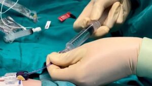 El Hospital General de Elche crea un equipo especializado para mejorar el acceso vascular de los pacientes